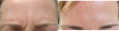 Botox before and after photo