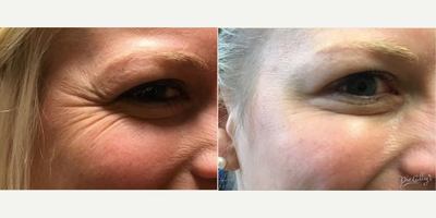 Botox before and after photo