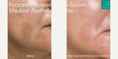Chemical Peel before and after photo