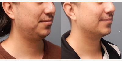 Chin Liposuction before and after photo