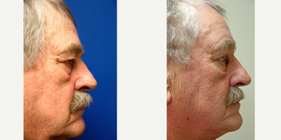 Eyelid Surgery before and after photo