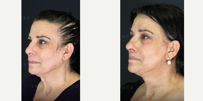 Neck Lift before and after photo