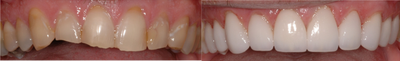 Porcelain Veneers before and after photo