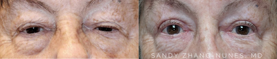 Ptosis Surgery before and after photo