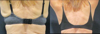 SculpSure before and after photo