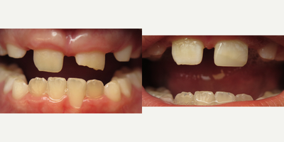Tooth Repair before and after photo