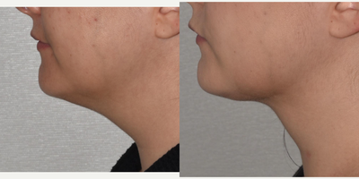 Vaser Liposuction before and after photo