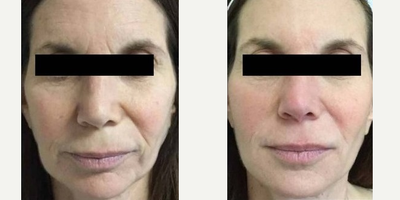 Botox before and after photo