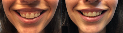 Botox before and after photo