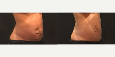 Emsculpt before and after photo