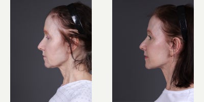 Facelift before and after photo