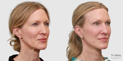 Facial Fat Transfer before and after photo
