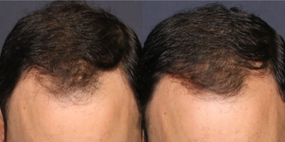FUE Hair Transplant before and after photo