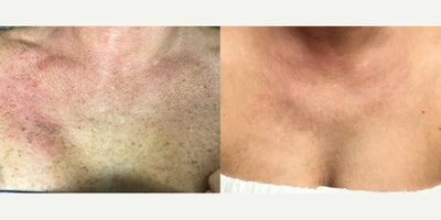 IPL before and after photo