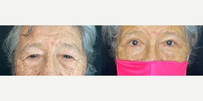 Ptosis Surgery before and after photo