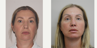 Deep Plane Facelift before and after photo