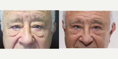 Eyelid Surgery before and after photo