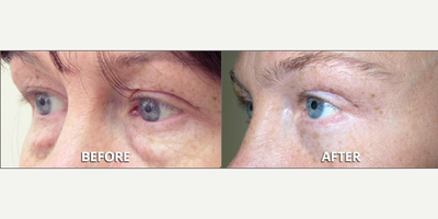 Eyelid Surgery before and after photo