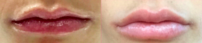 Juvederm before and after photo