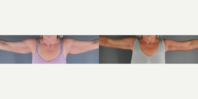 Arm Lift before and after photo