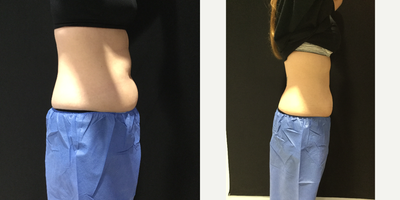 CoolSculpting before and after photo