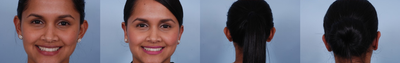 Ear Surgery before and after photo