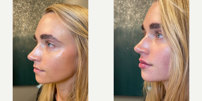 Juvederm before and after photo
