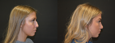 Rhinoplasty before and after photo