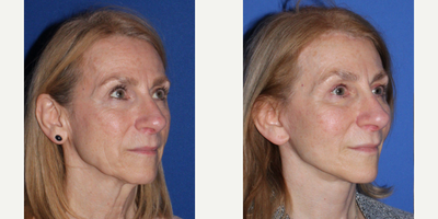 Cheek Lift before and after photo
