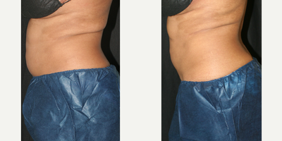 CoolSculpting before and after photo