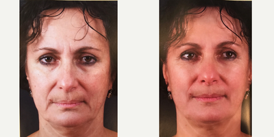Exilis before and after photo