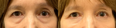 Eyelid Surgery before and after photo