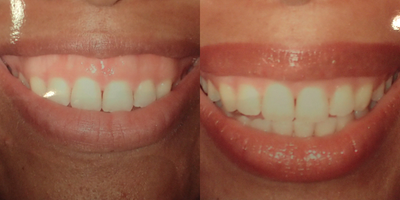 Lip Surgery before and after photo