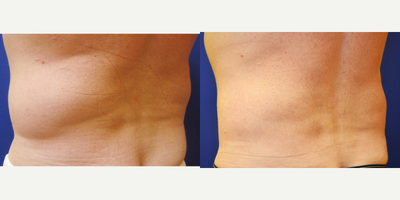 Liposonix before and after photo