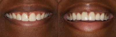 Porcelain Veneers before and after photo