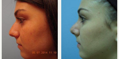 Rhinoplasty before and after photo