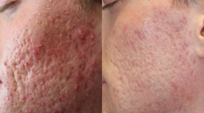 CO2 Laser before and after photo