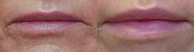 Dermal Fillers before and after photo