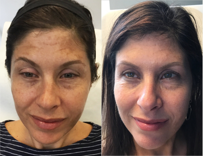 Dysport before and after photo
