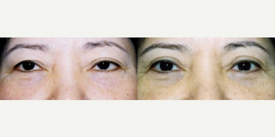 Eyelid Surgery before and after photo