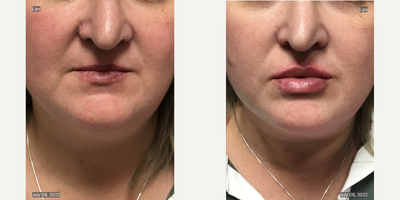Lip Fillers before and after photo