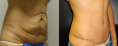 Tummy Tuck before and after photo