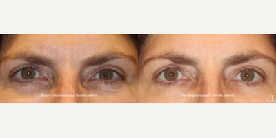 Eyelid Surgery before and after photo