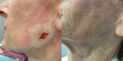 Mohs Surgery before and after photo