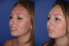 Rhinoplasty before and after photo