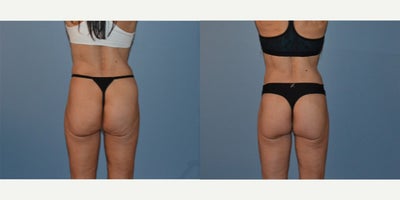 Body Lift before and after photo