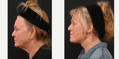 Neck Lift before and after photo