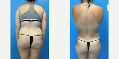 Smart Lipo before and after photo