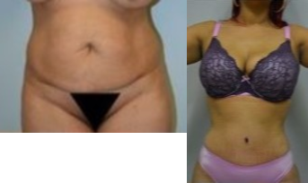 Tummy Tuck before and after photo