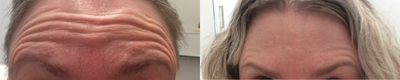 Botox before and after photo
